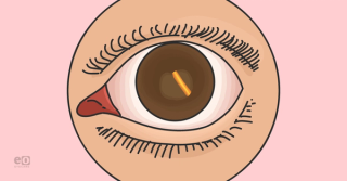 Intravitreal Corticosteroid Implants: What You Need to Know