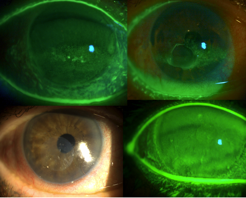 Dehydrated amniotic membrane