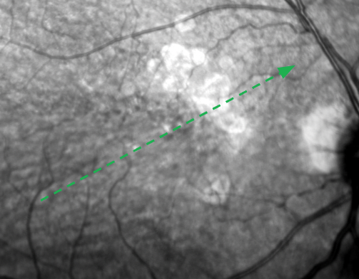 Near-infrared reflectance (NIR) imaging of the patient's right eye, geographic atrophy (GA) lesions show up as hyperreflective on NIR imaging.