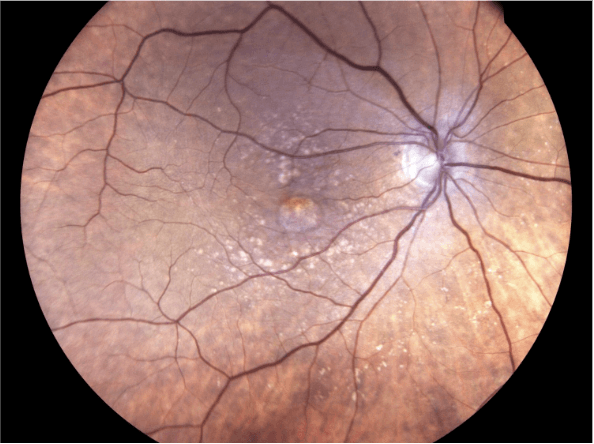 2 year Fundus OD