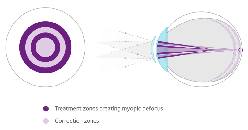 MiSight contact lens treatment zones