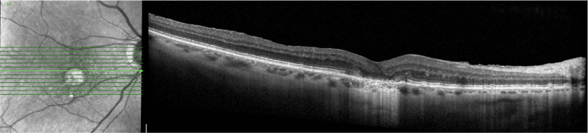 2 year NIR/OCT OD