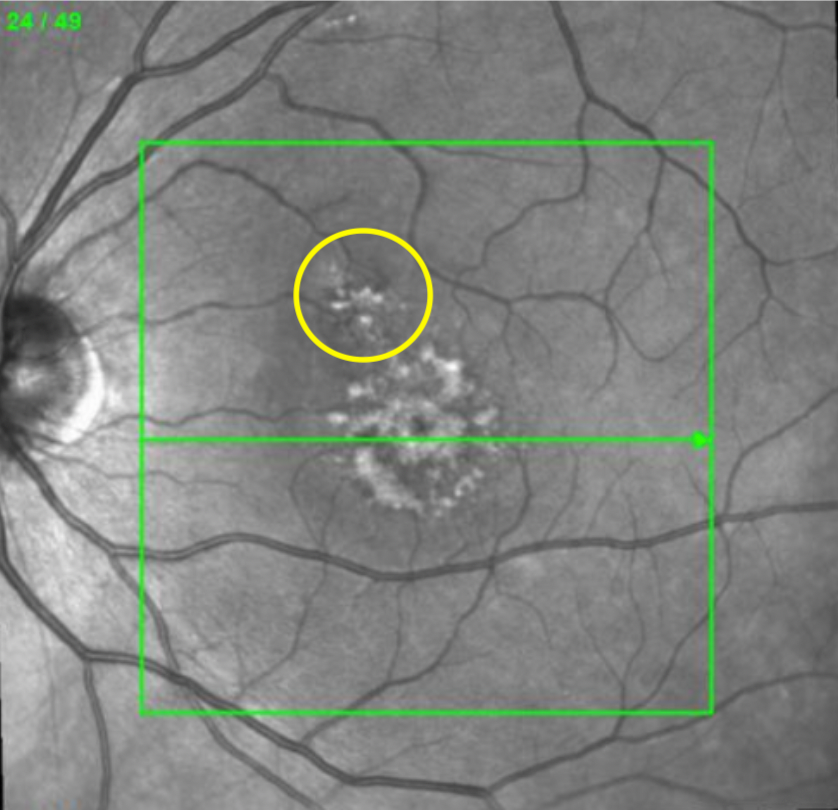 NIR Post-Laser