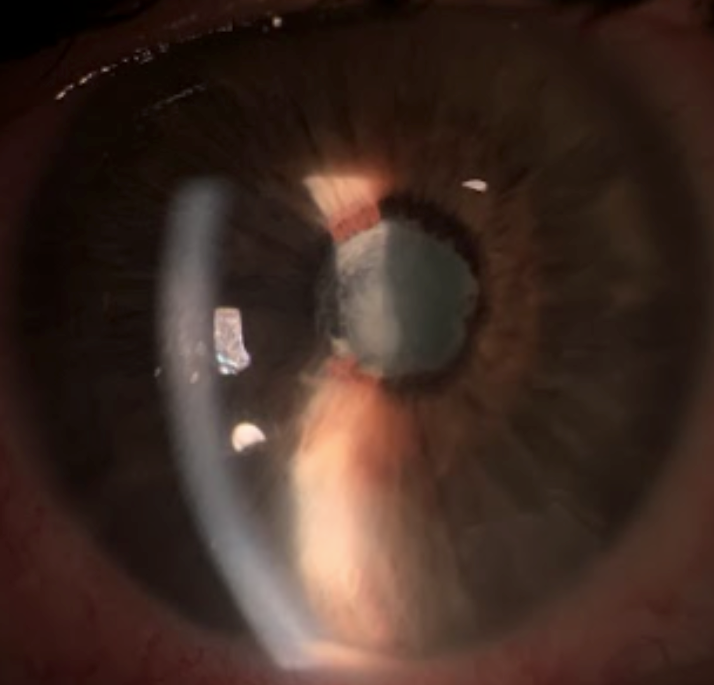 Acute anterior uveitis