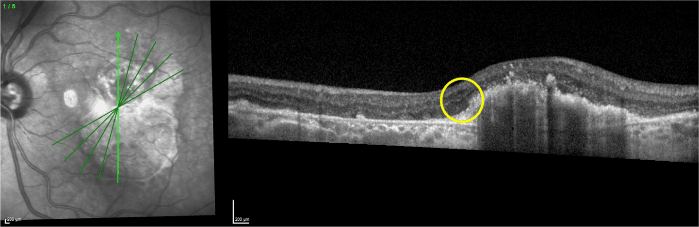 RPE Tear 18 Months Later