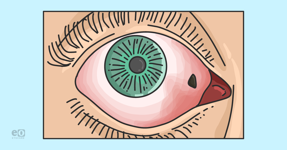 Diagnosing and Treating Secondary Glaucomas: A Complete Guide