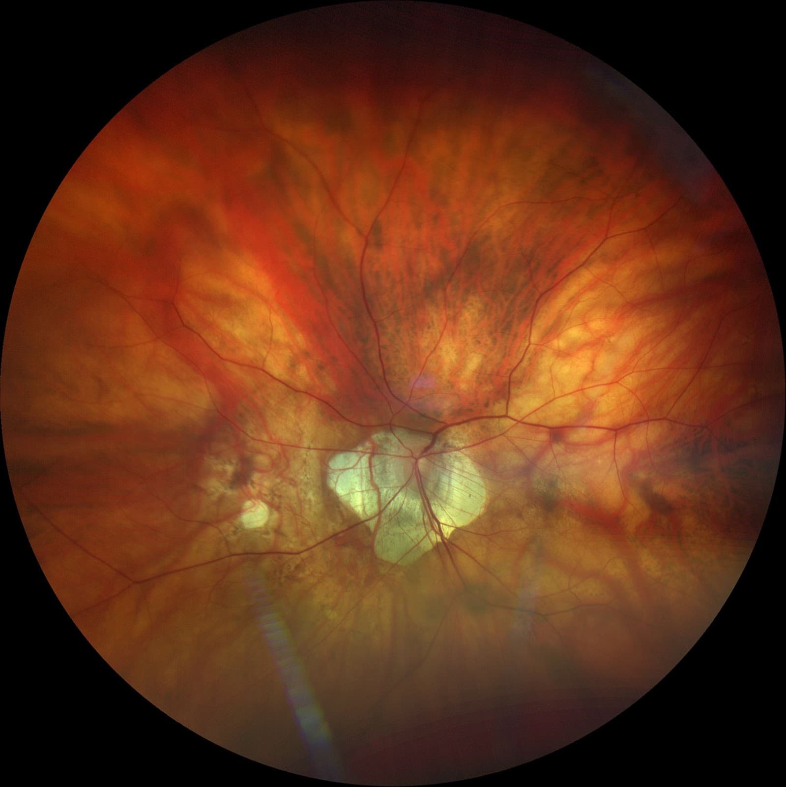 Managing Glaucoma with an Integrated Diagnostic Ecosystem