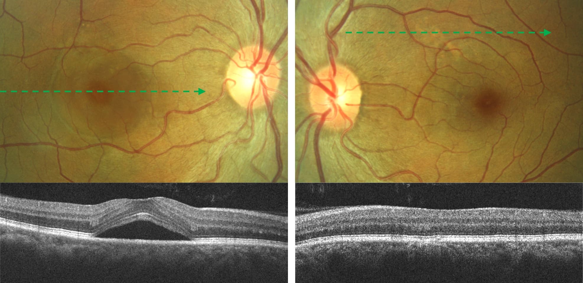 An Update on Central Serous Chorioretinopathy