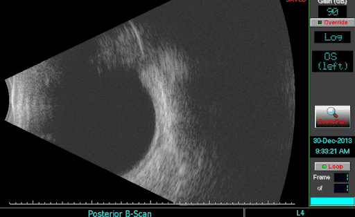 Differential Diagnosis for a Pigmented Fundus Lesion with Downloadable ...