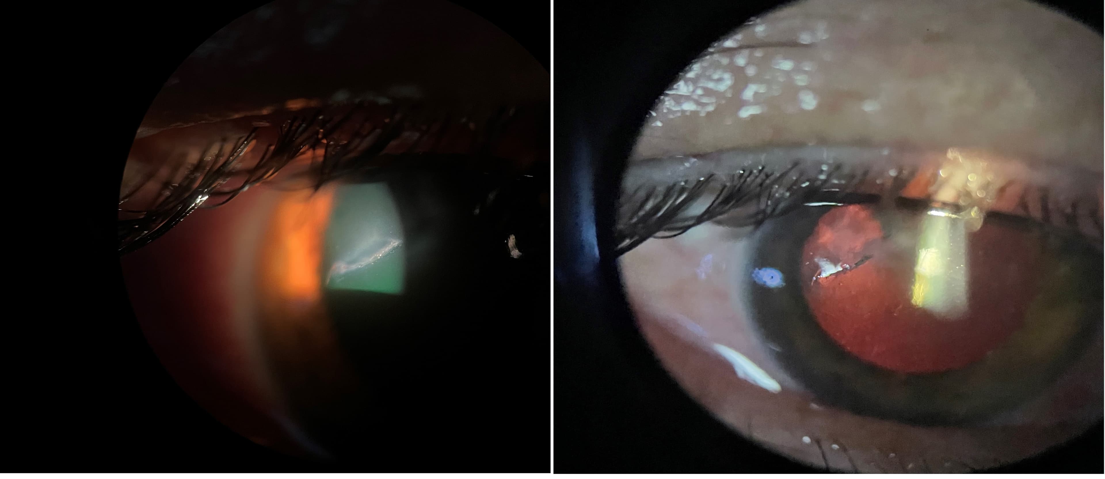 https://covalentcareers3.s3.amazonaws.com/media/original_images/Corneal_Laceration.jpg