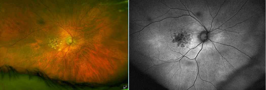 An Optometrist’s Guide to Fluorescein Angiography