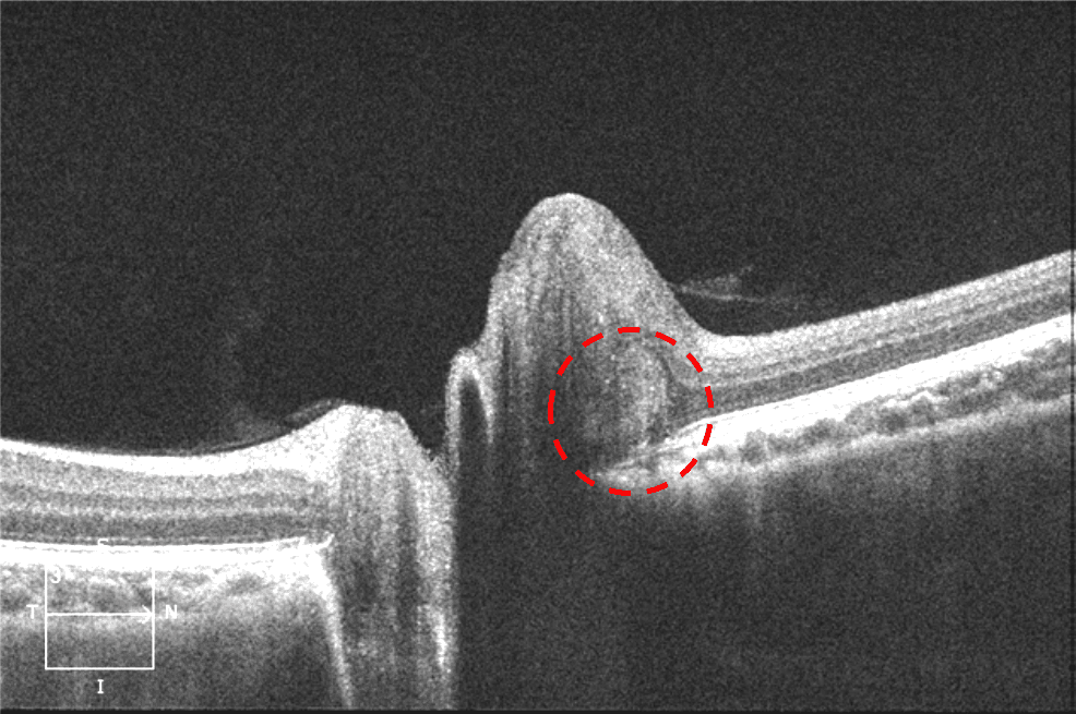 OCT of the Elevated Optic Nerve Head