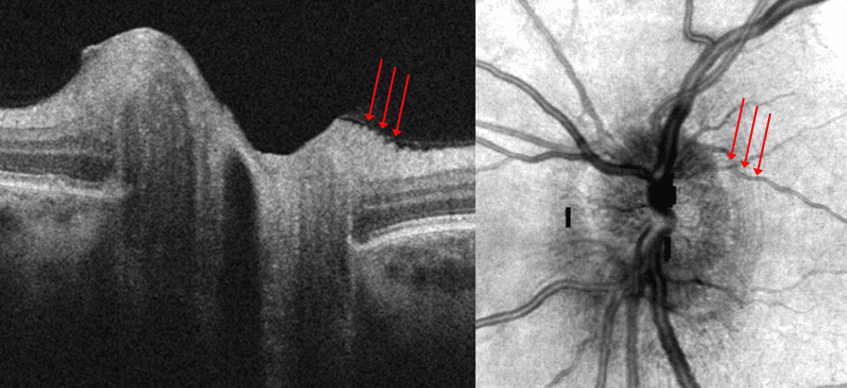 OCT of the Elevated Optic Nerve Head