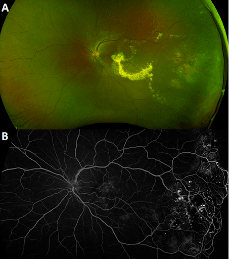 https://covalentcareers3.s3.amazonaws.com/media/original_images/Exudative_retinopathy.png