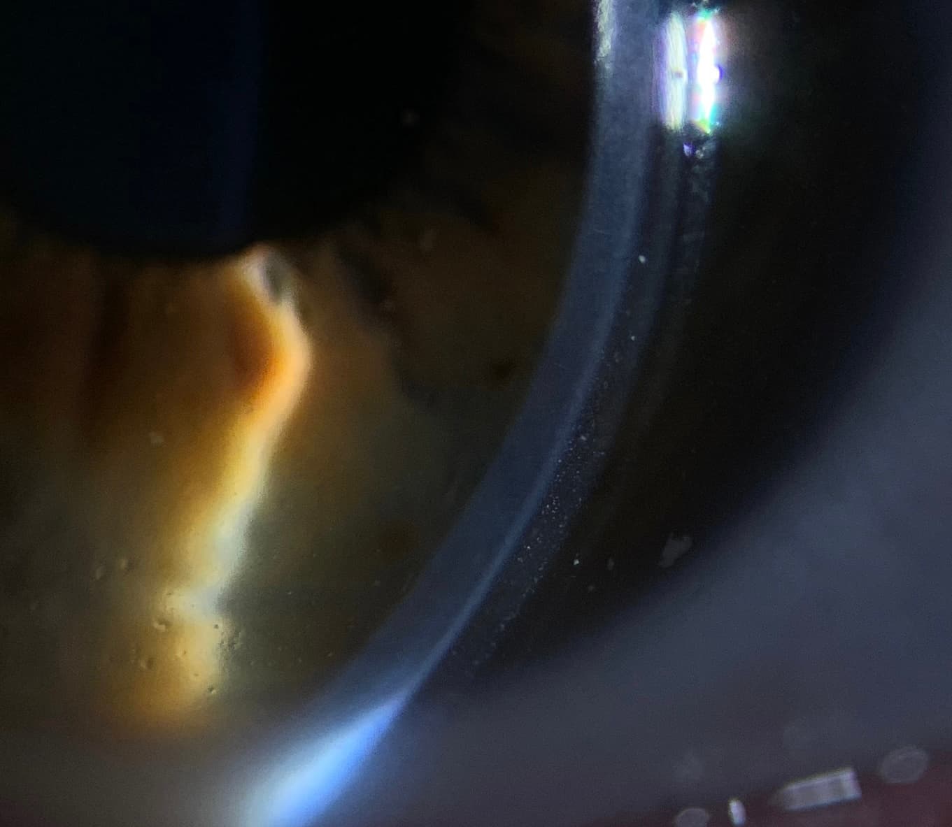 The Ultimate Guide to Scleral Lenses for Dry Eye