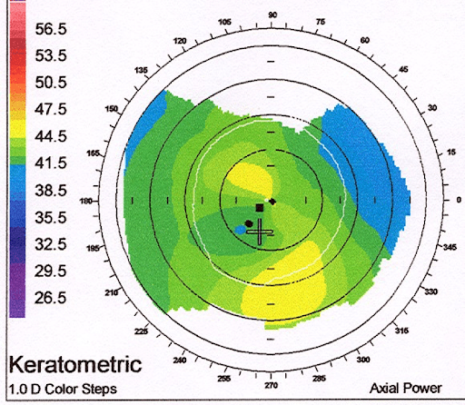 https://covalentcareers3.s3.amazonaws.com/media/original_images/LASIK_skew_deviation.png