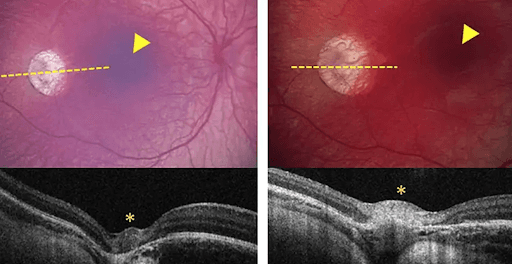 https://covalentcareers3.s3.amazonaws.com/media/original_images/OCT_of_Retinoblastoma.png