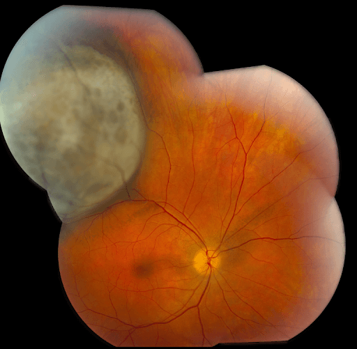 https://covalentcareers3.s3.amazonaws.com/media/original_images/Primary_Choroidal_Melanoma.png