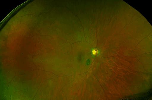 Differential Diagnosis for a Pigmented Fundus Lesion with Downloadable ...