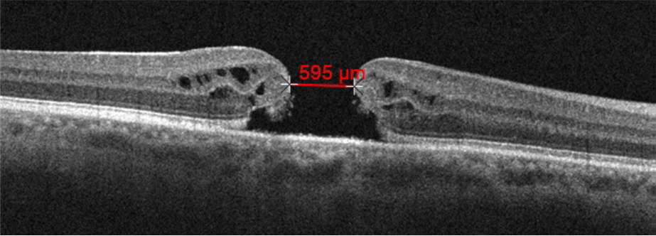 When Your Patient Develops a Full Thickness Macular Hole