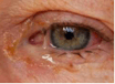 https://covalentcareers3.s3.amazonaws.com/media/original_images/bacterial-conjunctivitis-red-ey.png