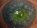 https://covalentcareers3.s3.amazonaws.com/media/original_images/corneal-abrasion-red-eye.png