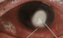 https://covalentcareers3.s3.amazonaws.com/media/original_images/corneal-ulcer-red-eye.png