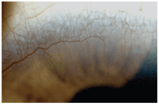 https://covalentcareers3.s3.amazonaws.com/media/original_images/corneal_neovascularization.png