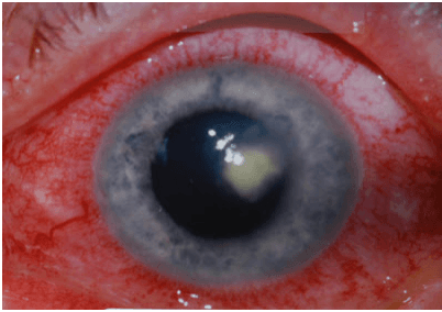 https://covalentcareers3.s3.amazonaws.com/media/original_images/corneal_ulcer.png