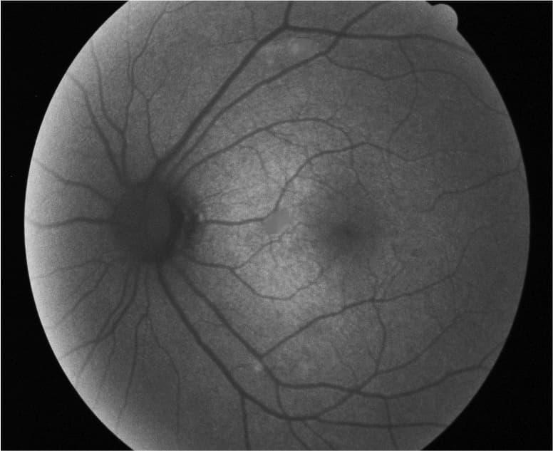 Putting The Fun In Fundus Autofluorescence (FAF)