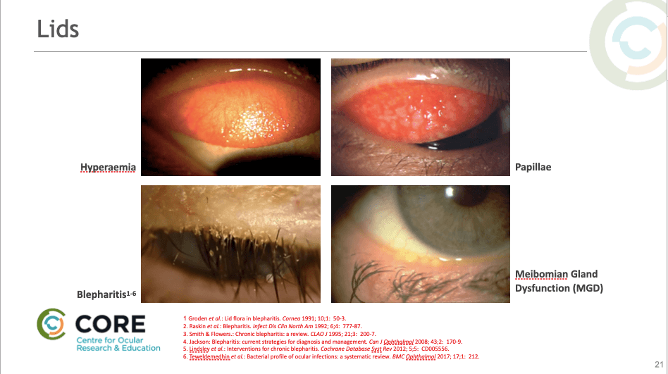 Why Contact Lens Selection Matters A Legend Explains