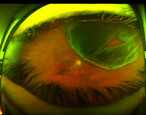 https://covalentcareers3.s3.amazonaws.com/media/original_images/large-retinal-tear.png