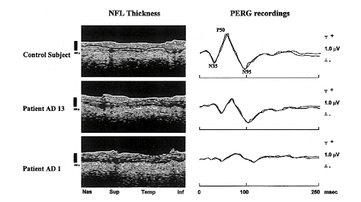 https://covalentcareers3.s3.amazonaws.com/media/original_images/nerve_fiber_layer_thickness.png