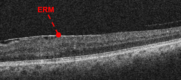 https://covalentcareers3.s3.amazonaws.com/media/original_images/oct-of-epiretinal-membrane-2.png