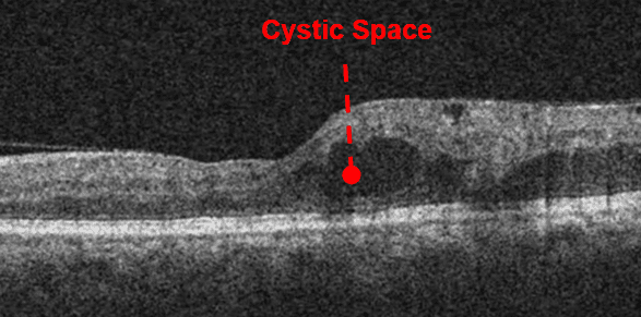 https://covalentcareers3.s3.amazonaws.com/media/original_images/oct-of-macular-edema.png