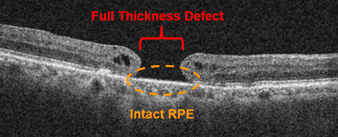 https://covalentcareers3.s3.amazonaws.com/media/original_images/oct-of-macular-hole-660x267.png