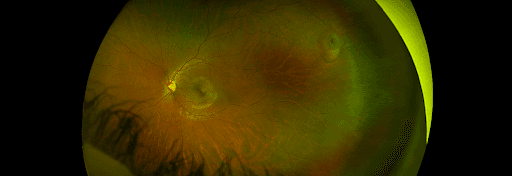 https://covalentcareers3.s3.amazonaws.com/media/original_images/retinal-hole.png