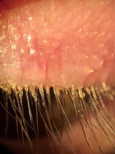 The Ultimate Guide To Demodex Blepharitis 