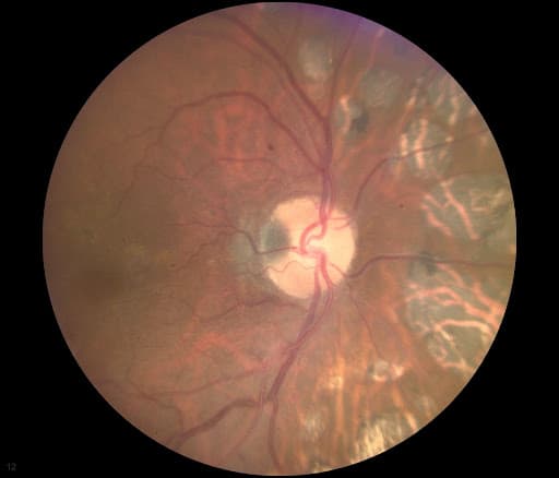 Differential Diagnosis for a Pigmented Fundus Lesion with Downloadable ...