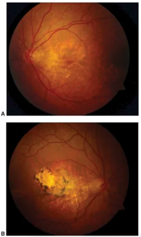 Sorsby macular dystrophy fundus