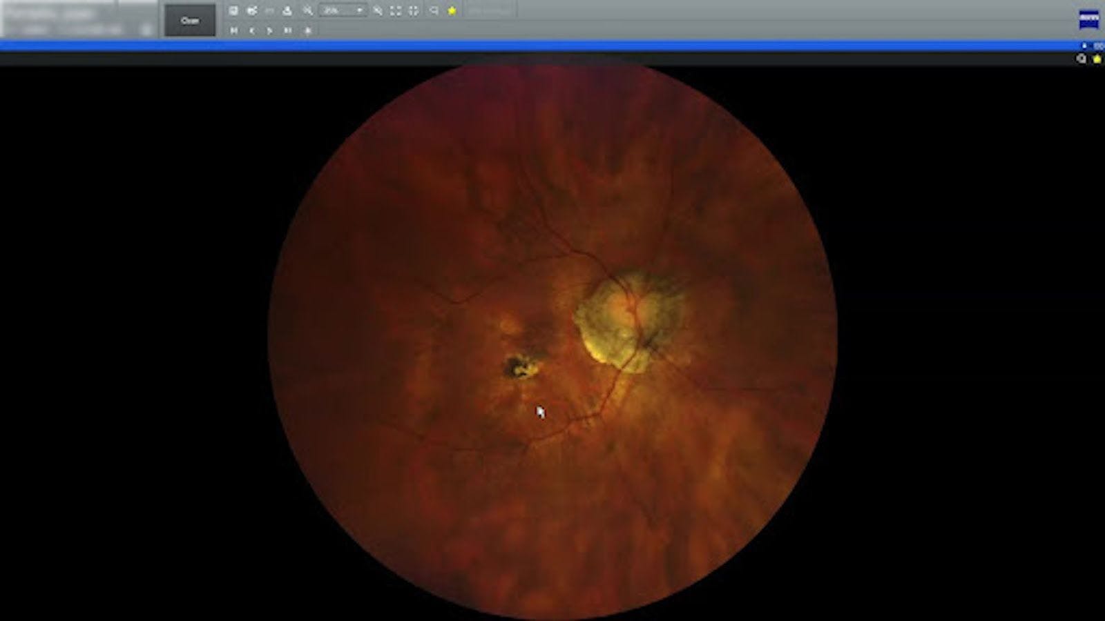 OCTA can provide insight into thinning and other retinal issues
