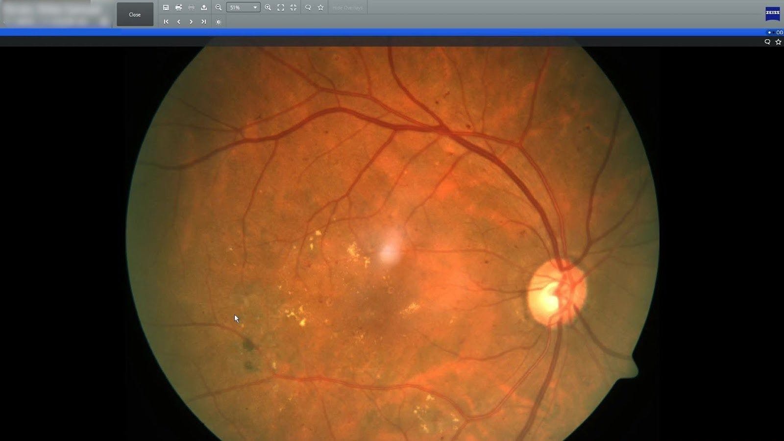 Retina image showing diabetic retinopathy and macular edema