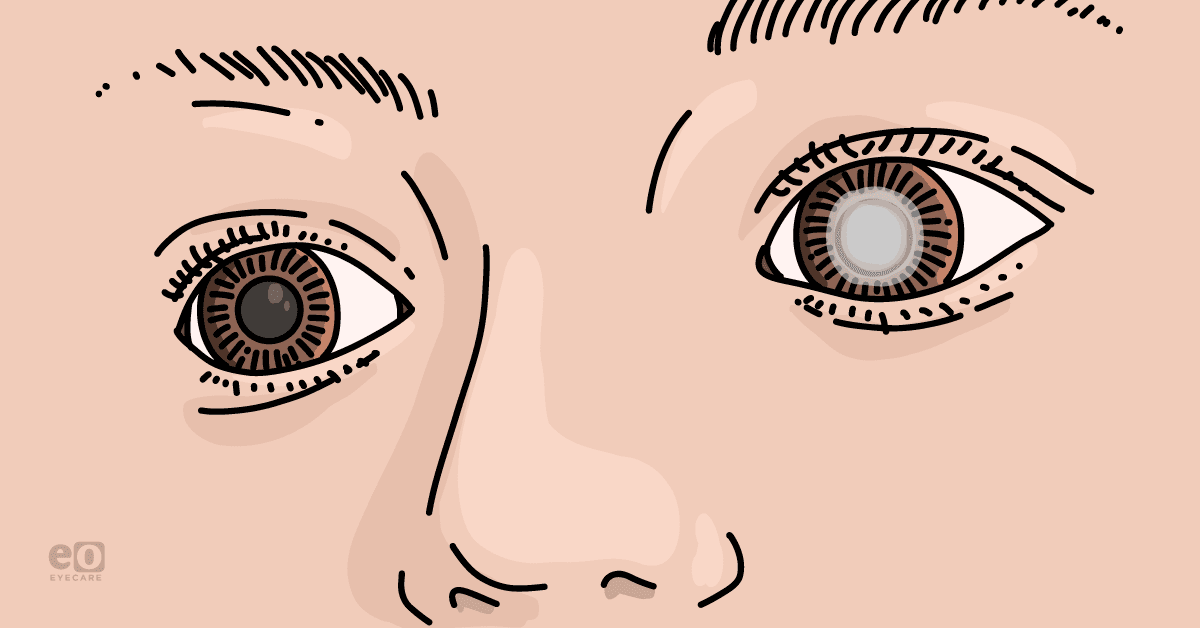 Closeup of the eyes of a child with pediatric glaucoma.