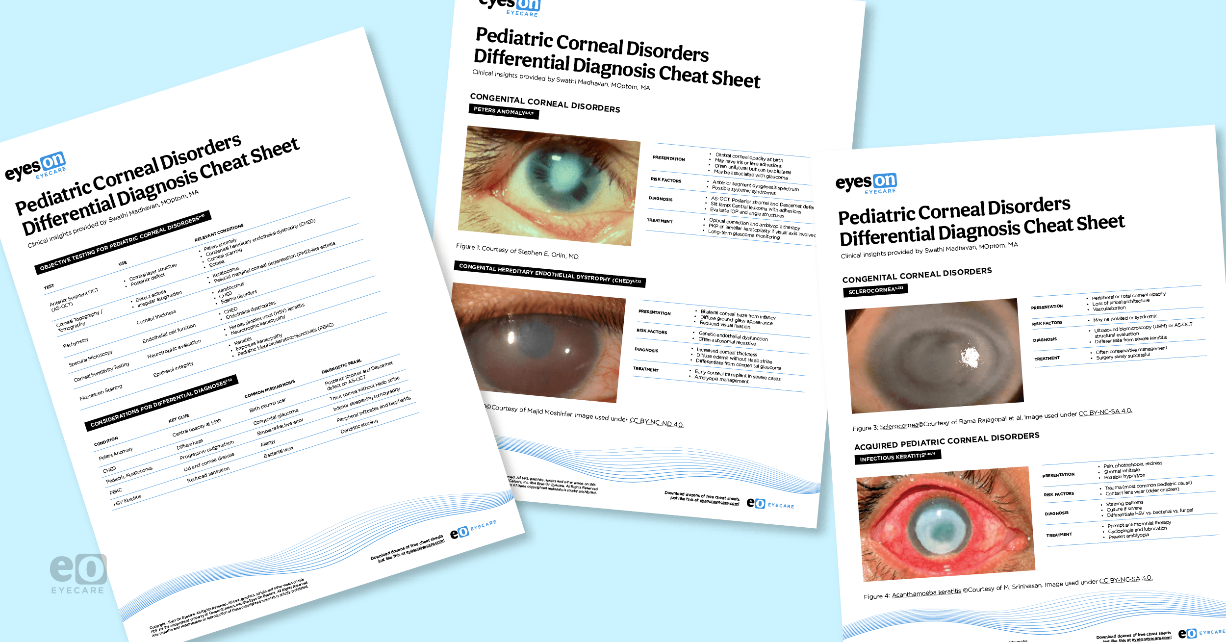 Corneal Disorders in Pediatric Patients with Differential Diagnosis Cheat Sheet