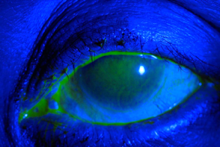 Scleral Lens Blue Light