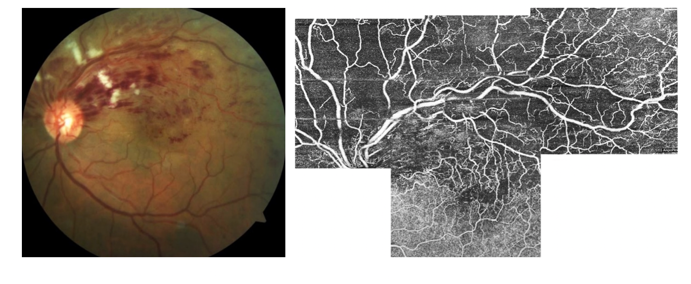  Fundus photography and OCTA scan of a left eye representing a superior branch retinal vein occlusion