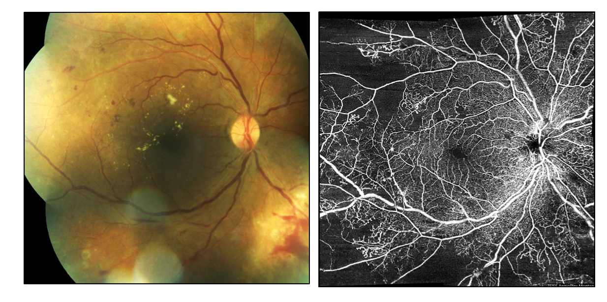 Ultra-widefield fundus photography and OCTA scan of a right eye in a non-proliferative diabetic retinopathic patient