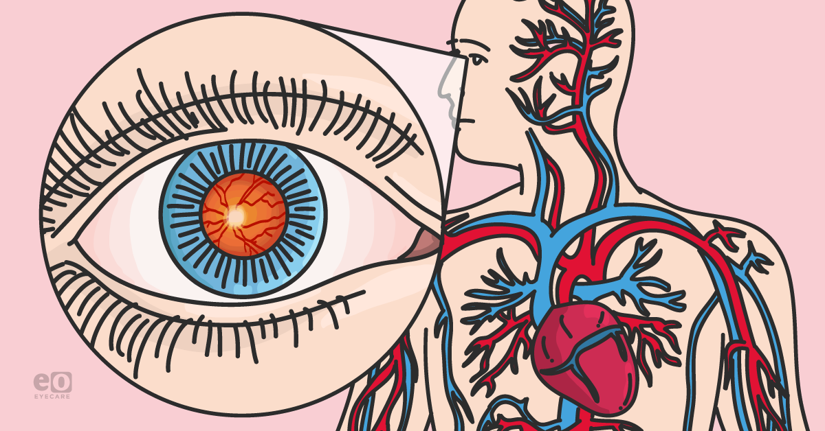 Ocular Manifestations of Common Cardiovascular Diseases