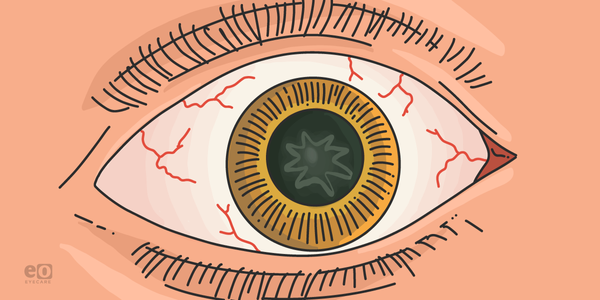 Management of Traumatic Cataracts