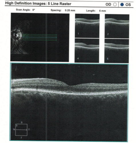 A 5-line raster OCT scan of a patient with hydroxychloroquine (HCQ) retinopathy.